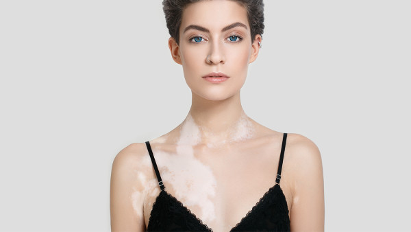 治白癜風(fēng)費(fèi)用是要多少呢