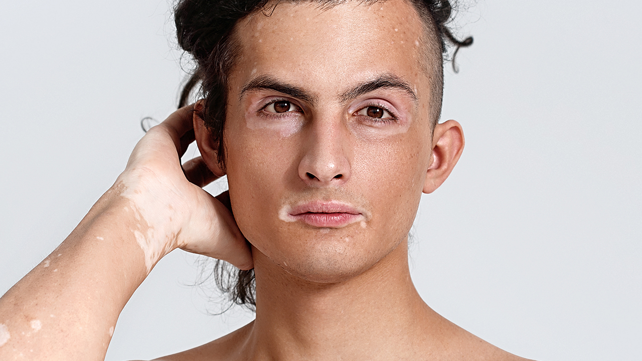 臉上有白色斑，白癜風(fēng)嗎