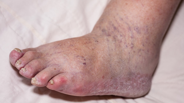 62歲有高血壓心絞痛能爬山嗎？