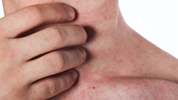 艾滋病患者頭暈是晚期嗎？