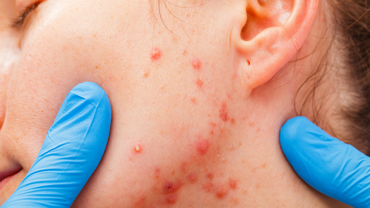 艾滋病患者護(hù)理注意事項(xiàng)