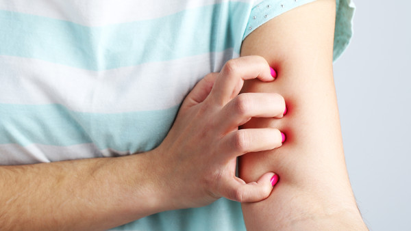 登革熱被蚊子咬了有紅點