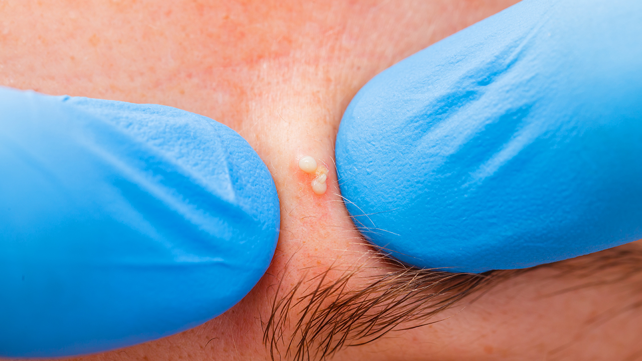 腋窩長小痘痘是狐臭嗎嗎