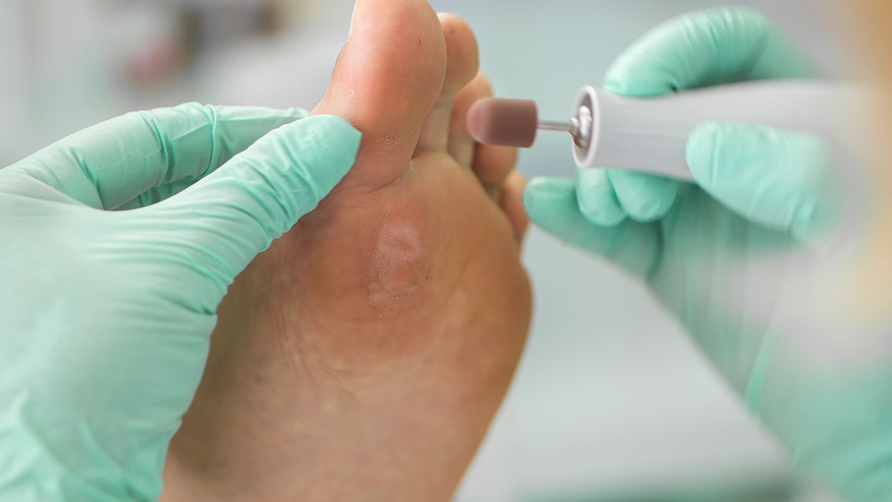 銹釘子扎傷了會(huì)長雞眼嗎