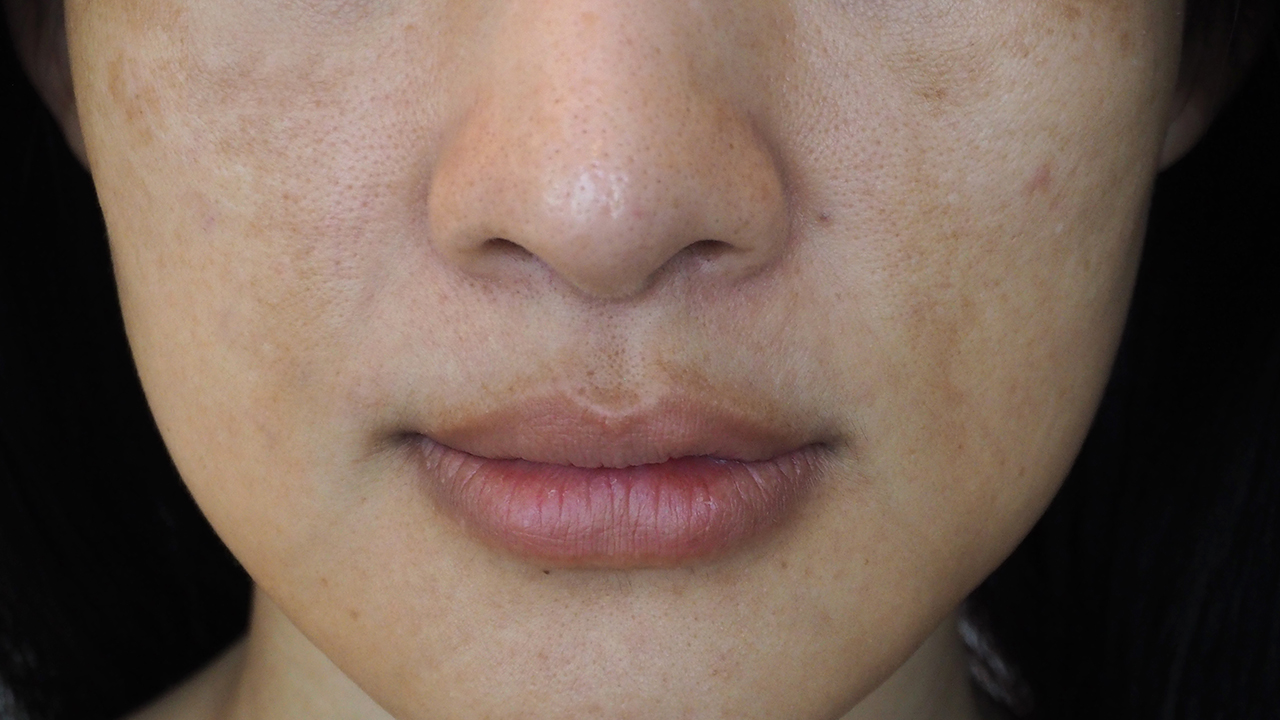 尋常疣貼了雞眼貼會(huì)怎樣