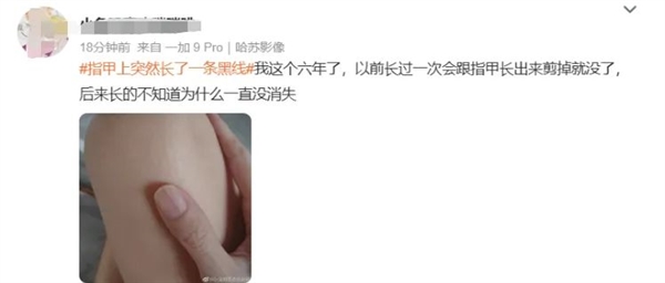 指甲出現(xiàn)一條黑線 別不當(dāng)回事！可能是癌變