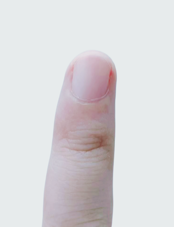指甲出現(xiàn)一條黑線 別不當(dāng)回事！可能是癌變